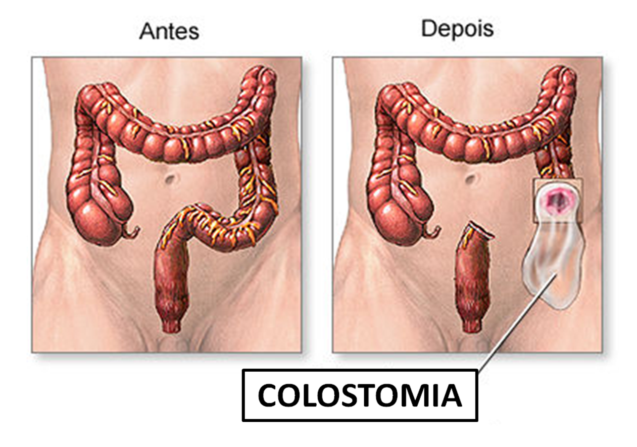 COLOSTOMIA