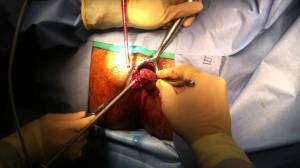 Hemorroidectomia_DrOzimoGama