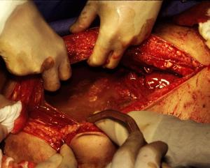 INTRA_ABDOMINAL_INFECTION