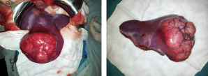 HEPATECTOMY_OZIMOGAMA