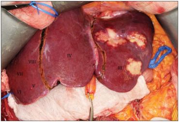 Liver_Metastases_Ozimo_Gama