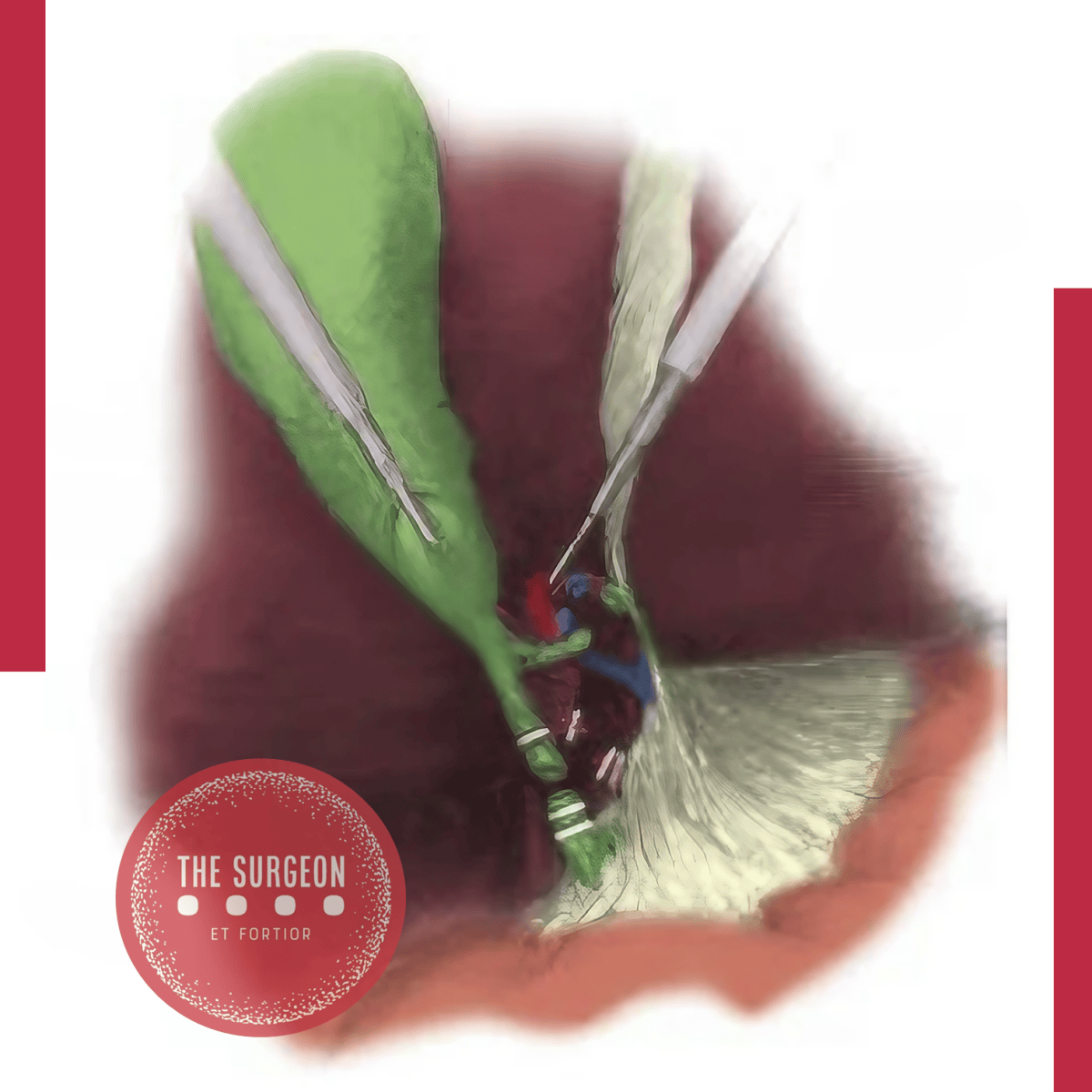 Picture of Mechanisms of Bile Duct Injury | The SURGEON